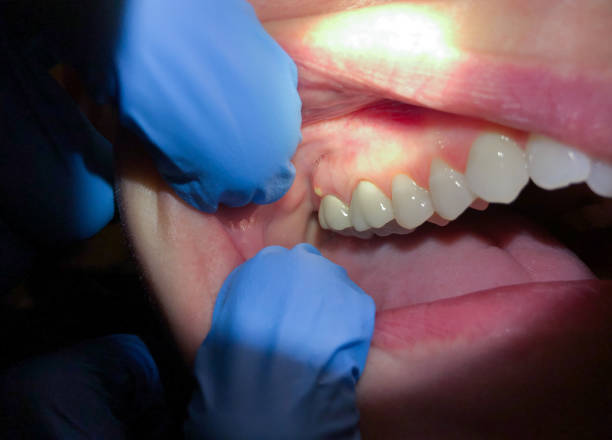 Best Emergency Care for Gum Disease in Delavan Lake, WI