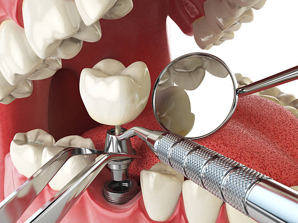 Best Emergency Wisdom Tooth Extraction in Delavan Lake, WI
